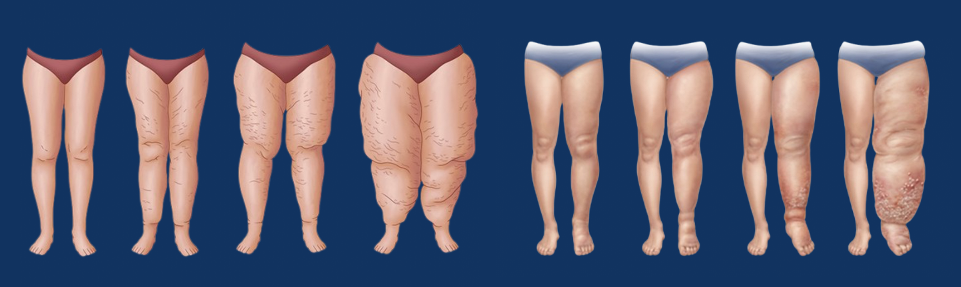 FCSM online - Linfedema, Lipedema e Cellulite